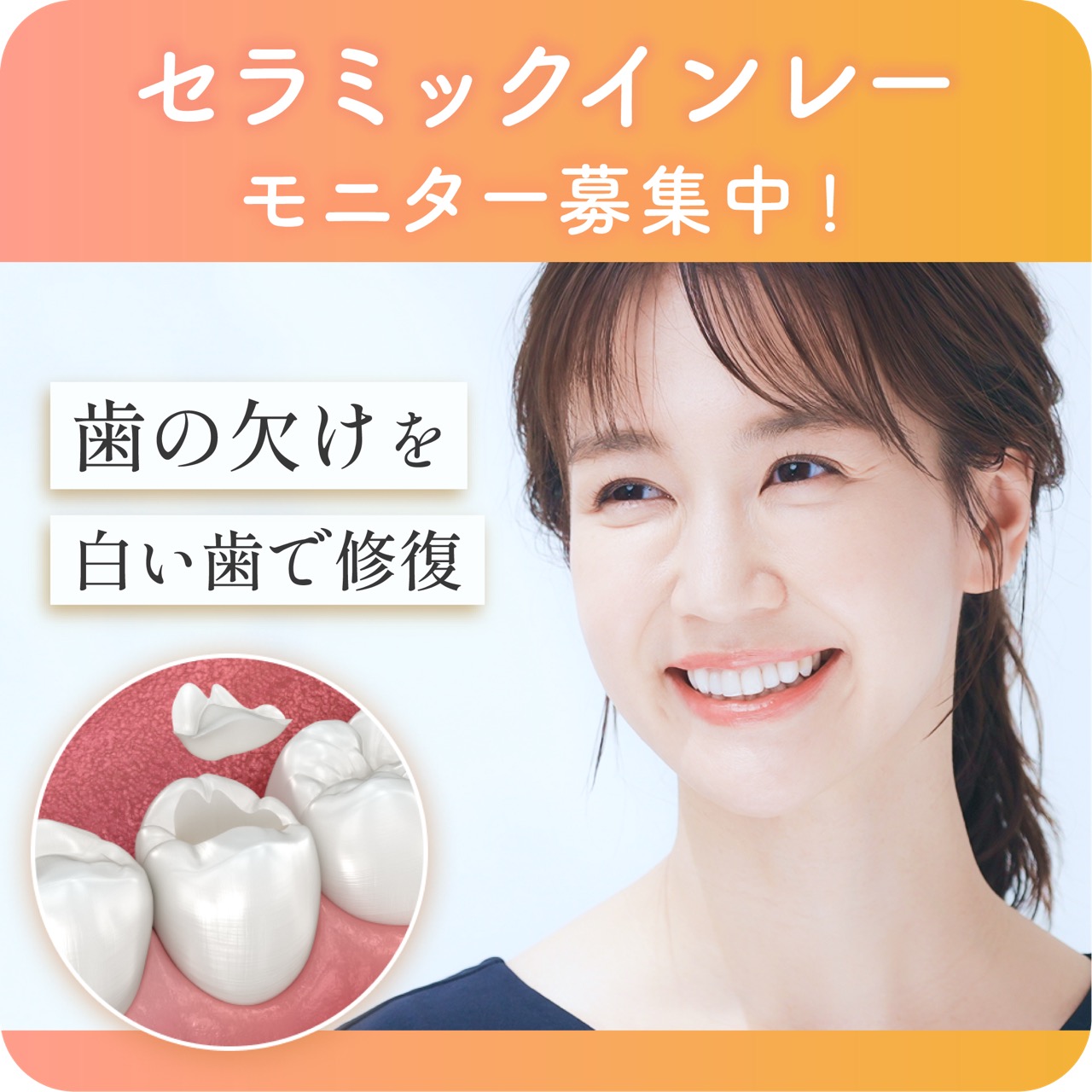 セラミックインレーモニター募集