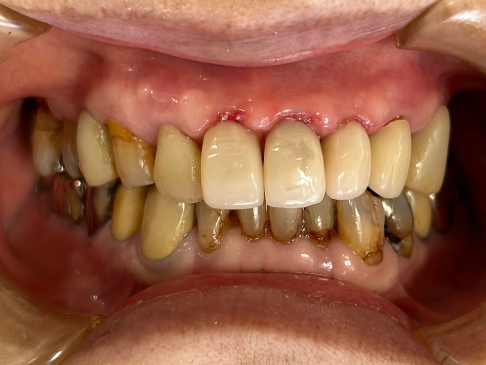 術後　CADクラウン