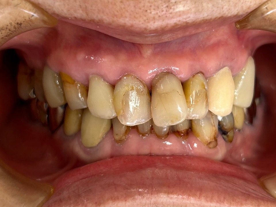 術前　CADクラウン