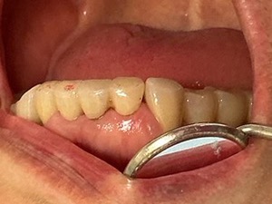 術後 ジルコニア