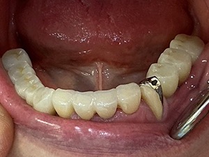 術前 ジルコニア