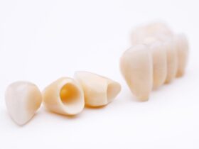 差し歯が取れたら接着剤で付けて大丈夫？取れる前兆・原因と正しい対処法を解説