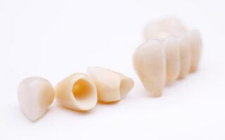 差し歯が取れたら接着剤で付けて大丈夫？取れる前兆・原因と正しい対処法を解説