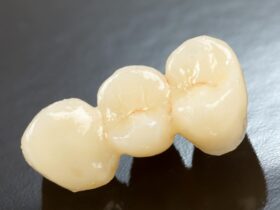 治療して被せ物をした歯が痛い理由は？原因別の対処法も解説