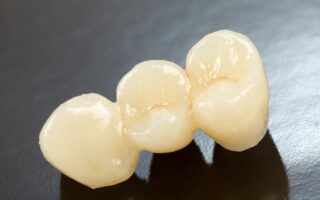 治療して被せ物をした歯が痛い理由は？原因別の対処法も解説