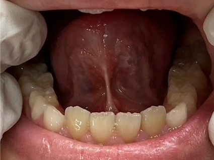 症例写真 舌小帯切除術 術前
