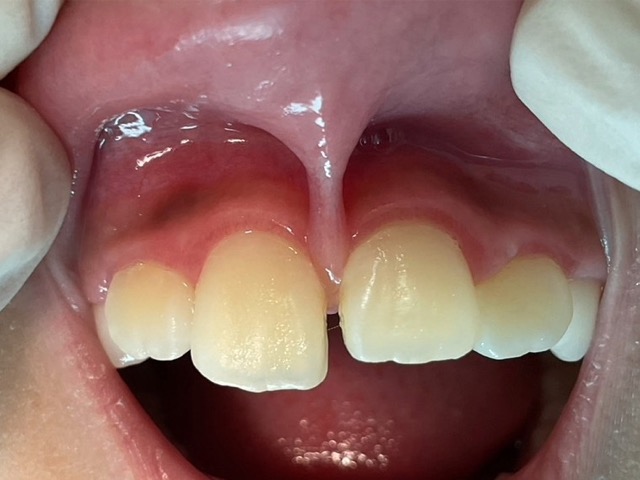 症例写真 上唇小帯切除術 術前